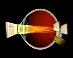 Chicago LASIK corrects Myopia